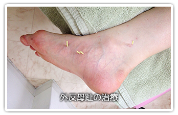 外反母趾の治療